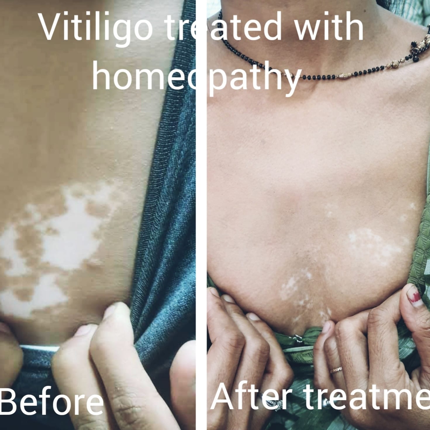 Before and After Vitiligo patient recovery Pune